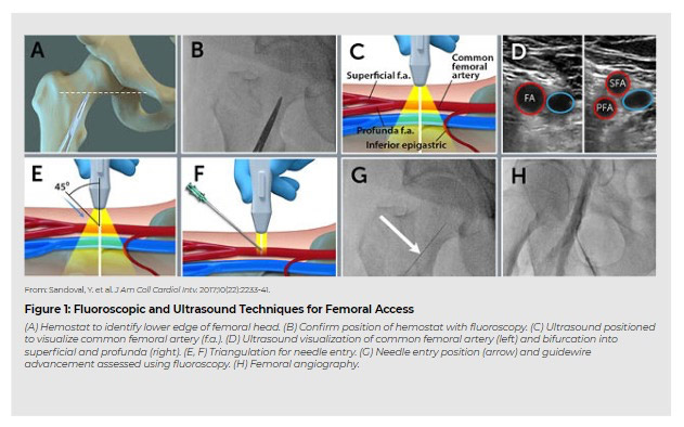 Flouroscopic and ultrasound techniques for femoral access